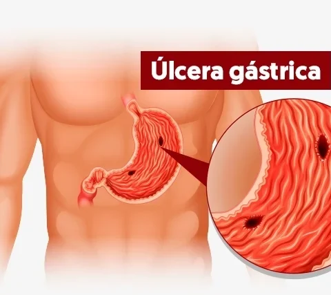 ulceras gastricas