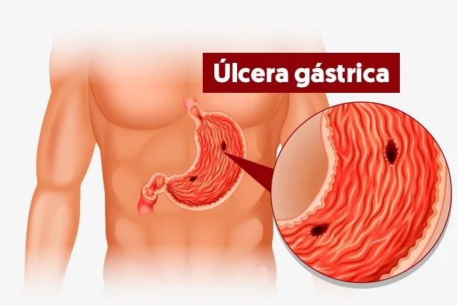 ulceras gastricas